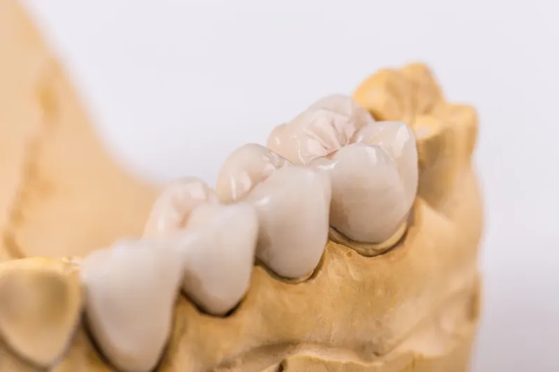 Functional & Durable Restorations