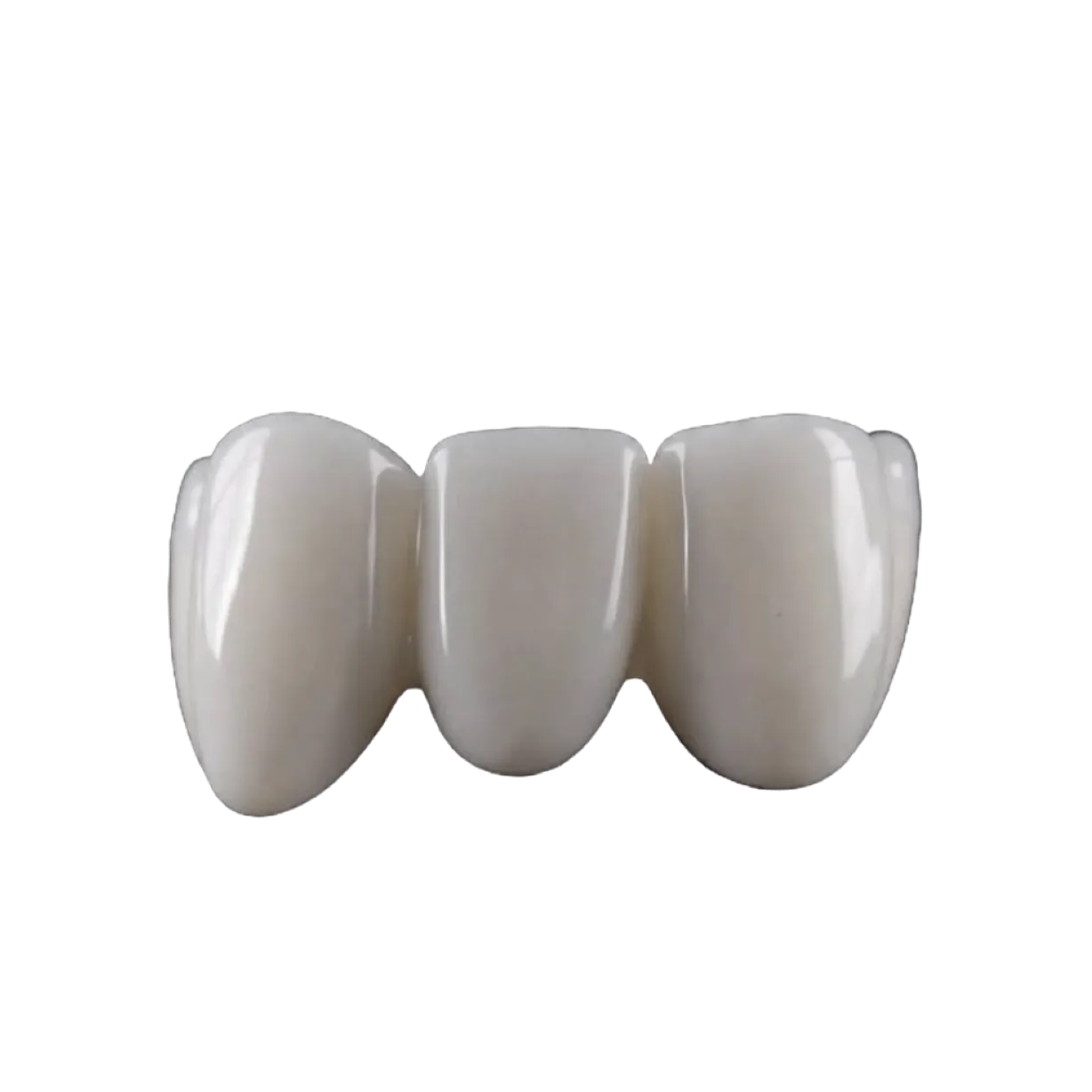 Milled Composite Veneer/Onlay